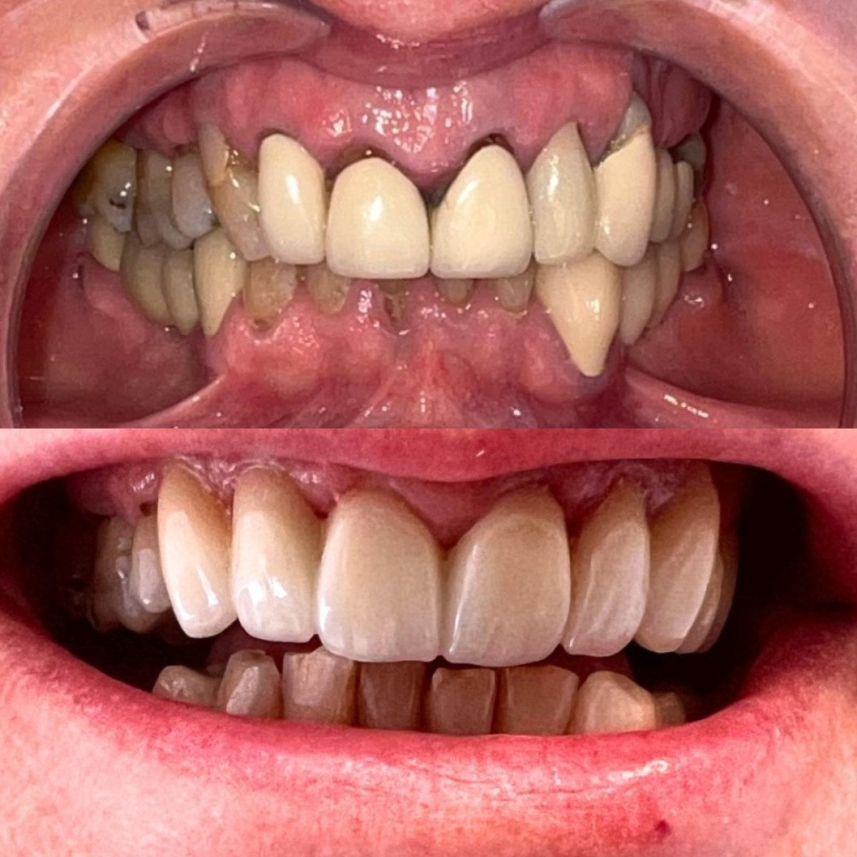 نتائج قبل وبعد تركيب تيجان الأسنان في Clínica Dental Raíces، ابتسامة محسنة
