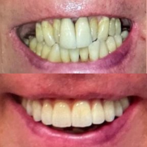 Before and after All-on-6 dental implants result at Clínica Dental Raíces, improved smile