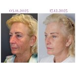 Vorher-nachher-Ergebnis der Blepharoplastik in der Db'est Clinic – Lidkorrektur