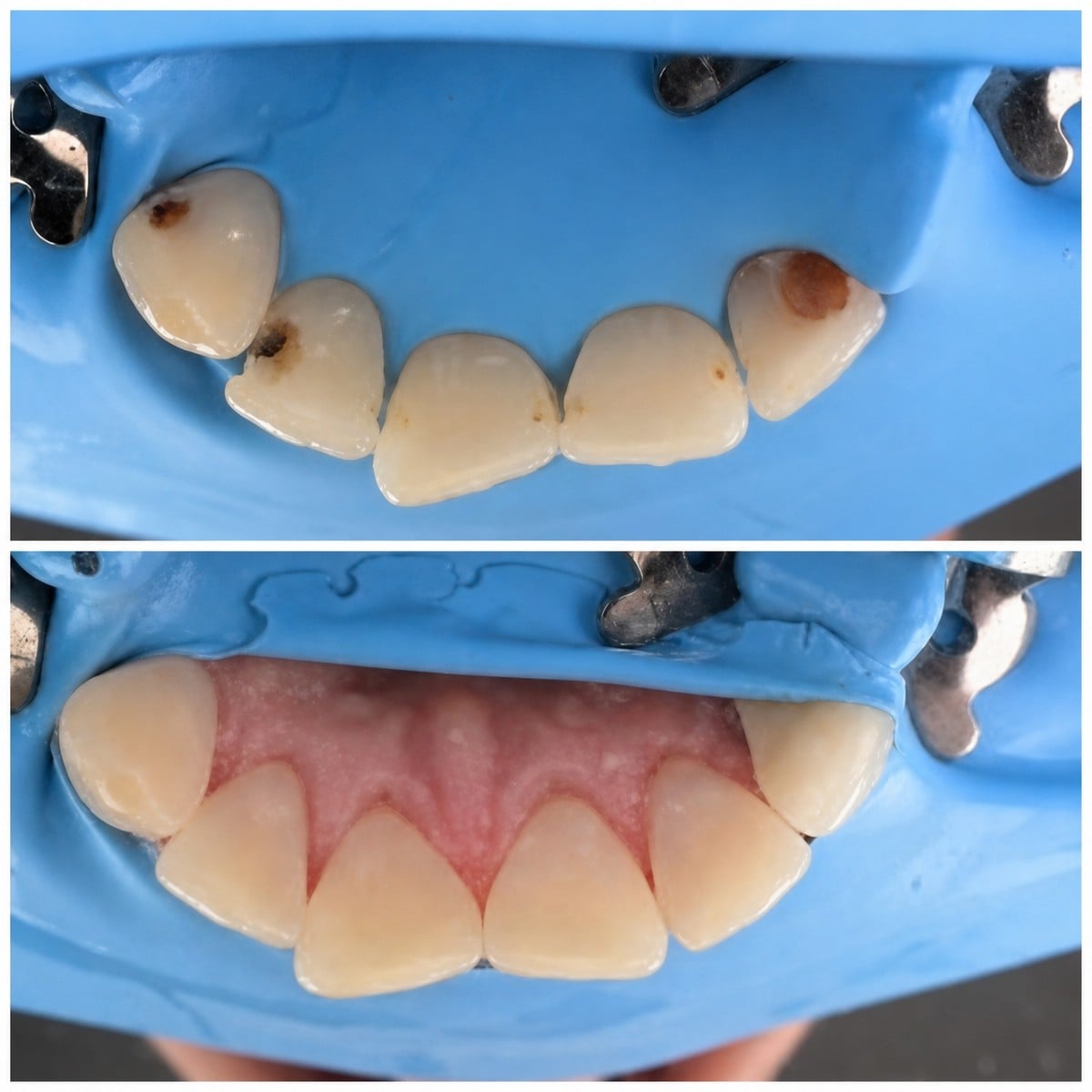 نتائج قبل وبعد حشو تجميلي مركب في عيادة RIKOTA Dental Clinic، ترميم الأسنان