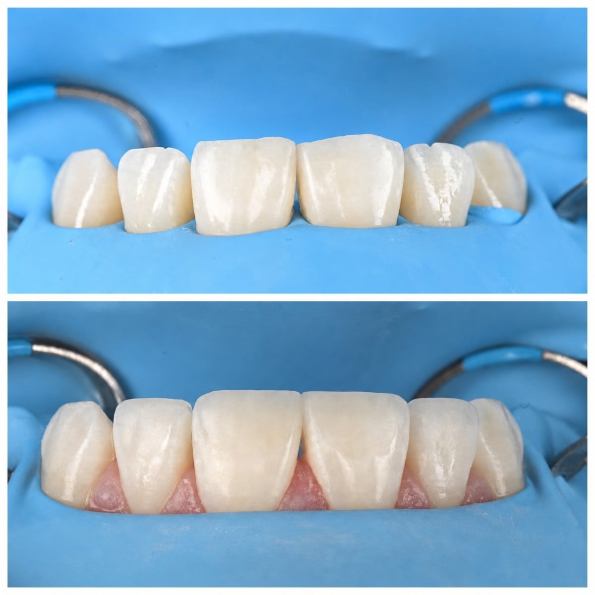 نتائج قبل وبعد حشو تجميلي مركب في عيادة RIKOTA Dental Clinic، ابتسامة محسنة