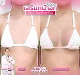 Before and after breast augmentation result at Somchai Clinic with 260cc Mentor Xtra Gel