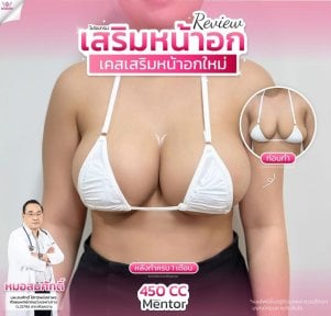 Before and after breast augmentation results at Somchai Clinic with 450cc Mentor implants