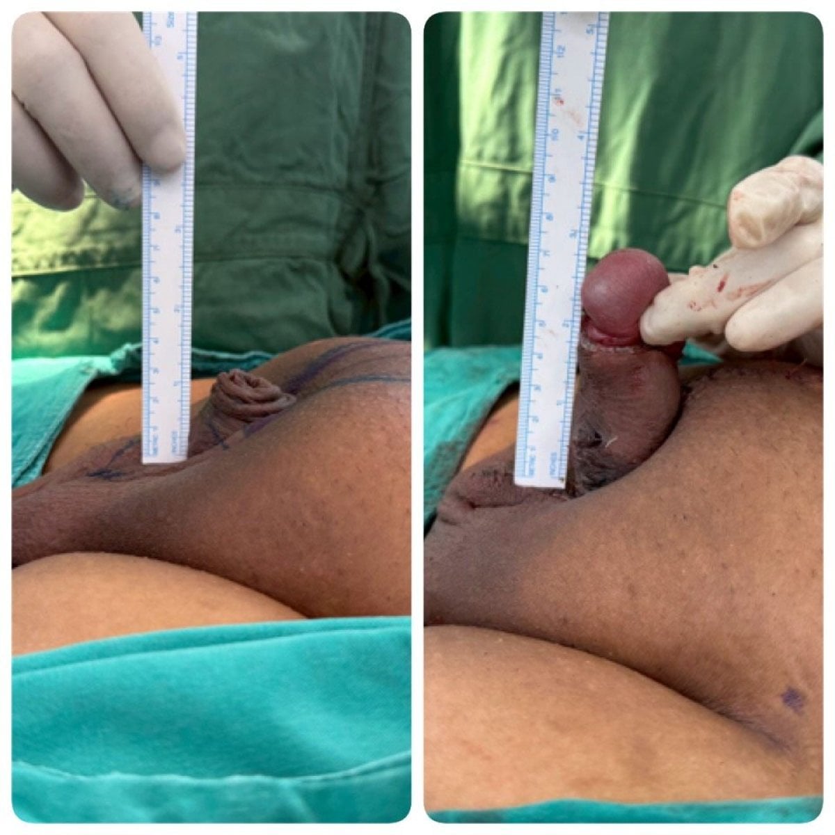 Resultados antes y después de aumento de pene en Eternity Clinic Phuket By Dr.Beer, mayor longitud