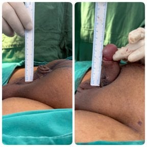 Before and after penis enlargement results at Eternity Clinic Phuket By Dr.Beer, visible length gain
