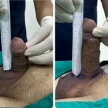 Before and after penis enlargement results at Eternity Clinic Phuket By Dr.Beer, visible length gain