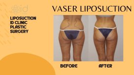Before and after Vaser liposuction results at ID Clinic Bangkok, visible body contouring