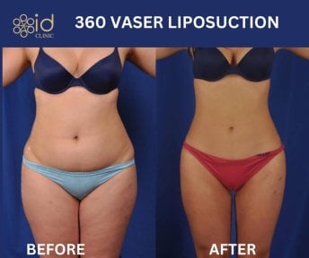Before and after 360 Vaser liposuction results at ID Clinic Bangkok, body contour improvement