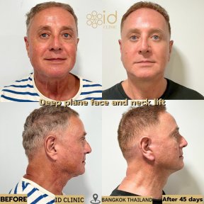 Before and after deep plane face and neck lift results at ID Clinic Bangkok, 45 days post-op
