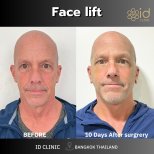 Before and after mini facelift results at ID Clinic Bangkok, visible facial rejuvenation