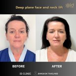 Before and after deep plane face and neck lift results at ID Clinic Bangkok, visible rejuvenation