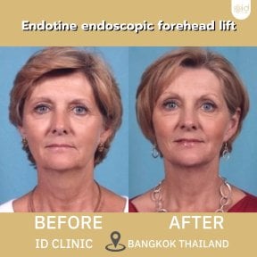 Before and after endotine endoscopic forehead lift results at ID Clinic Bangkok, visible lift effect