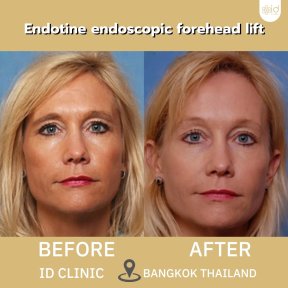 Before and after endotine endoscopic forehead lift results at ID Clinic Bangkok Thailand