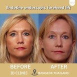 Before and after endotine endoscopic forehead lift results at ID Clinic Bangkok Thailand