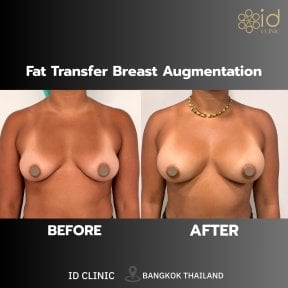 Before and after breast augmentation with fat transfer results at ID Clinic Bangkok