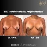 Before and after breast augmentation with fat transfer results at ID Clinic Bangkok