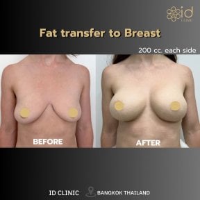 Before and after breast augmentation with fat transfer results at ID Clinic Bangkok