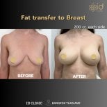 Before and after breast augmentation with fat transfer results at ID Clinic Bangkok