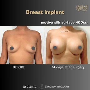 Before and after breast augmentation with Motiva implants at ID Clinic Bangkok, visible results