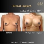 Before and after breast augmentation with Motiva implants at ID Clinic Bangkok, visible results