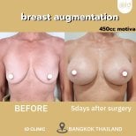 Before and after breast augmentation results at ID Clinic Bangkok with 450cc Motiva implants