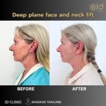 Before and after deep plane facelift and neck lift results at ID Clinic Bangkok