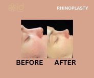 Before and after rhinoplasty results at ID Clinic Bangkok, nose reshaping with natural look