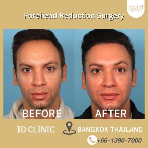 Forehead reduction surgery before and after results at ID Clinic Bangkok, visible improvement
