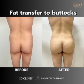 Before and after fat transfer to buttocks at ID Clinic Bangkok, enhanced contour result