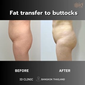 Before and after fat transfer to buttocks at ID Clinic Bangkok, visible contour improvement result