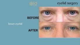 Before and after lower eyelid surgery results at ID Clinic Bangkok, reduced under-eye bags