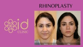 Before and after rhinoplasty results at ID Clinic Bangkok, nose reshaping with natural look