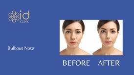 Before and after rhinoplasty for bulbous nose at ID Clinic Bangkok, refined nose result