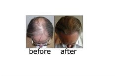 Before and after hair transplant results at ID Clinic Bangkok – restored fuller hairline