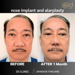 Before and after nose implant and alarplasty results at ID Clinic Bangkok, improved nose shape