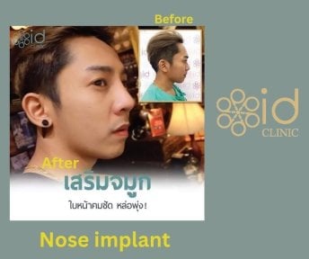 Before and after nose implant results at ID Clinic Bangkok, improved nose shape and profile