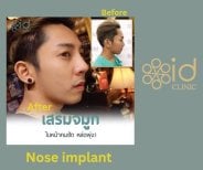 Before and after nose implant results at ID Clinic Bangkok, improved nose shape and profile