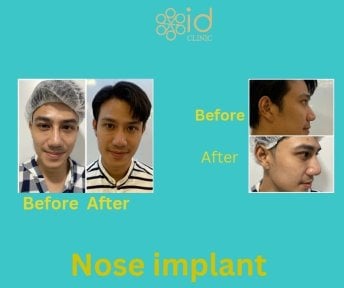 Before and after nose implant results at ID Clinic Bangkok, improved nose shape and profile