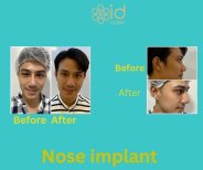 Before and after nose implant results at ID Clinic Bangkok, improved nose shape and profile