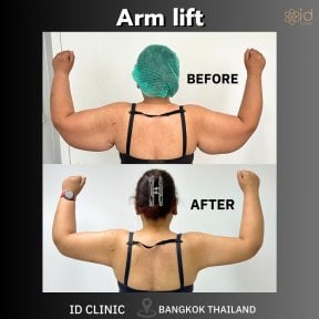Before and after arm lift results at ID Clinic Bangkok showing slimmer, toned upper arms