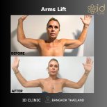 Before and after arm lift results at ID Clinic Bangkok, improved arm contour and firmness