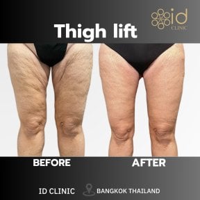 Before and after thigh lift results at ID Clinic Bangkok – smoother, firmer thigh contour
