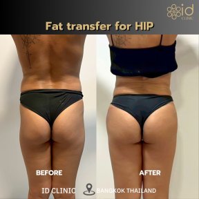 Before and after fat transfer for hip at ID Clinic Bangkok, visible hip contour improvement result