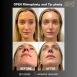 Before and after open rhinoplasty and tip plasty results at ID Clinic Bangkok, nose reshaping