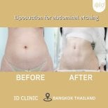 Before and after liposuction for abdominal etching at ID Clinic Bangkok, defined abs result