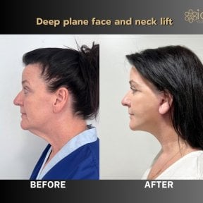 Before and after deep plane facelift and neck lift results at ID Clinic Bangkok, rejuvenated profile