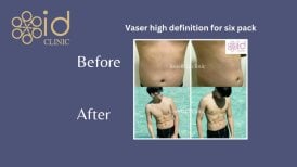 Before and after Vaser liposuction for six pack at ID Clinic Bangkok, defined abs result