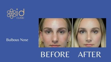 Before and after rhinoplasty for bulbous nose at ID Clinic Bangkok, refined nose result