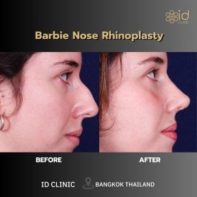 Before and after Barbie nose rhinoplasty results at ID Clinic Bangkok, refined nose shape