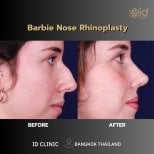 Before and after Barbie nose rhinoplasty results at ID Clinic Bangkok, refined nose shape